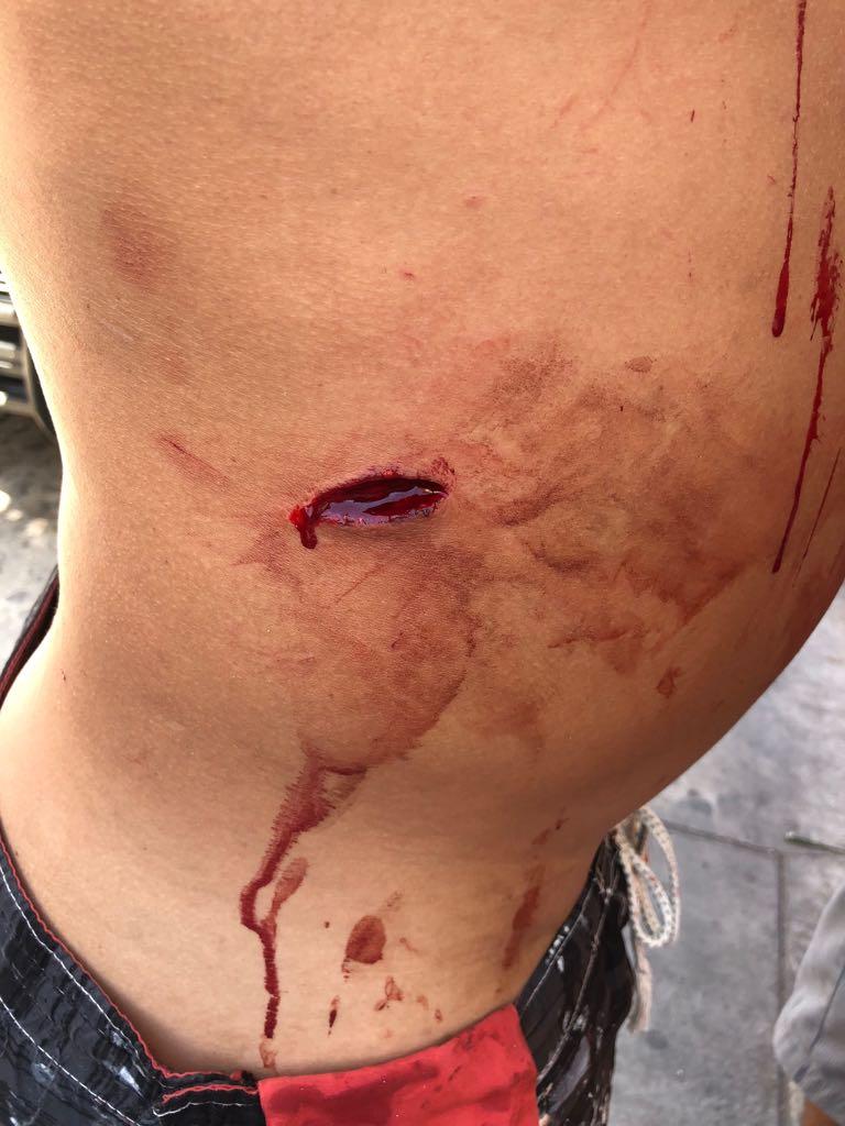30y31Sucesos (5) Carpintero se cortó un dedo