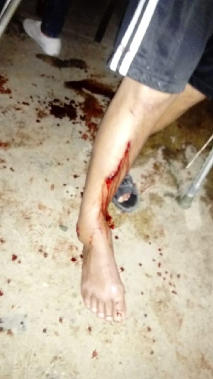 30y31Sucesos (1) Se quebró una pierna
