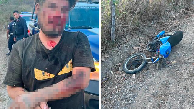 Motociclista se amputa un dedo al derrapar en la carretera de Valle a Bucerías Motociclista se amputa un dedo al derrapar en la carretera de Valle a Bucerías